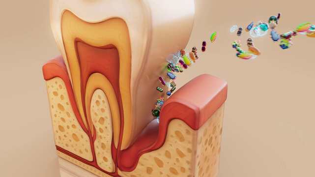 Conceptual 3D illustration of periodontitis with bacteria under the gums