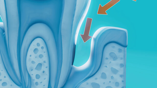Conceptual 3D illustration of human periodontitis