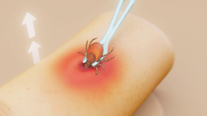 Conceptual 3D illustration of the removal of a tick from human skin