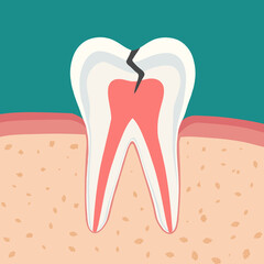 치과 치아치료 tooth treatment