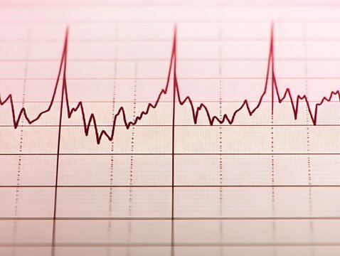 ECG Heartbeat Waveform Medical Data Graph Chart