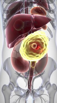 3D animation of cholecystitis, showing an inflamed gallbladder and gallstone