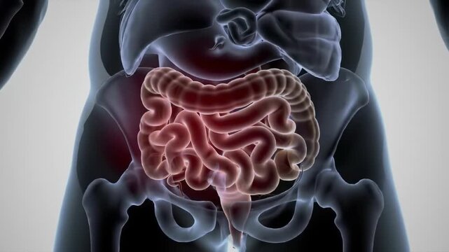 3D medical animation of an inguinal hernia with intestine protruding