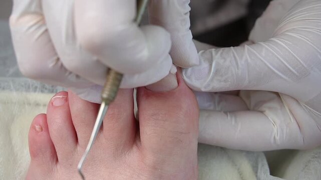 Procedure for treating an ingrown toenail. The podiatrist cleans the nail fold and inserts a sterile tampon to reduce inflammation and prevent the nail from growing in