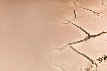 Dry skin presented as double exposure with cracked soil