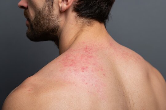 Skin redness and irritation on a man s back post massage featuring pimples red spots and bruises