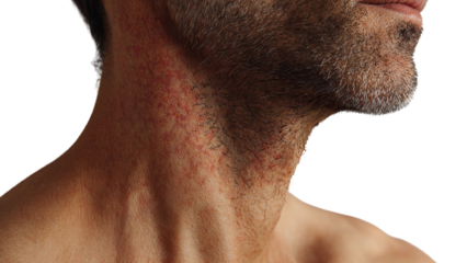 PNG of Close-up of a middle-aged Caucasian man's neck showing skin irritation and facial hair.