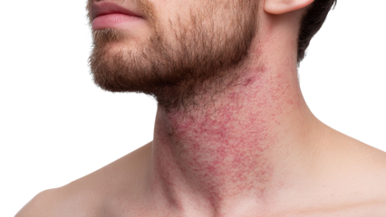 PNG of Close-up of a male with fair skin showing skin irritation on the neck and beard area.