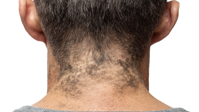 PNG of Close-up of a man’s nape revealing a unique pattern of hair growth on the neck, showcasing natural hair texture.