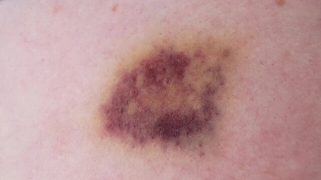 The bruise on skin close-up view. Various shades of healing process. Dark purple and yellow bruising colors on white skin. The violence concept. The consequences of injury. High quality 4k footage.