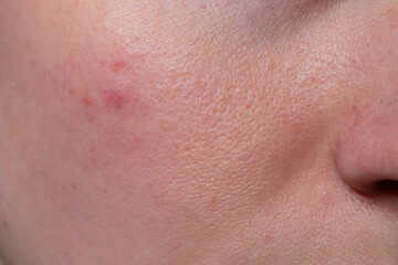 Close-up macro of facial skin with acne and visible pores. Red inflamed pimple, irritated texture and dermatology skin issue. Ideal for medical or skincare related content.