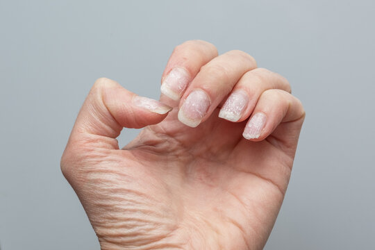 Damaged natural fingernails after gel polish removal on human hand close-up. A natural hand with problematic cuticles and broken nails. Emotional stress. Age-related skin changes. Hand care