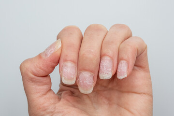 Damaged natural fingernails after gel polish removal on human hand close-up. A natural hand with...