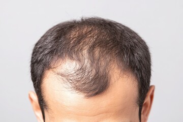 Fototapeta premium Medical Background. Closeup of Young Man with Hair Loss Problem for Health Care and Shampoo Product Concept