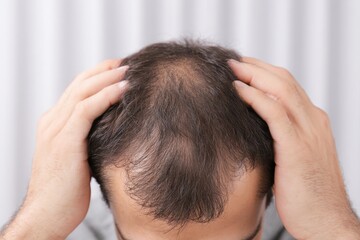 Fototapeta premium Medical Background. Young Man with Hair Loss Issue on White Backdrop for Health and Beauty Concept.