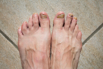 Micose com infe&ccedil;&atilde;o f&uacute;ngica em ambas as unhas dos p&eacute;s.