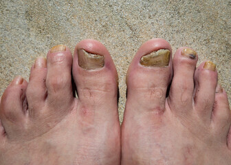 Micose com infeção fúngica em ambas as unhas dos pés.