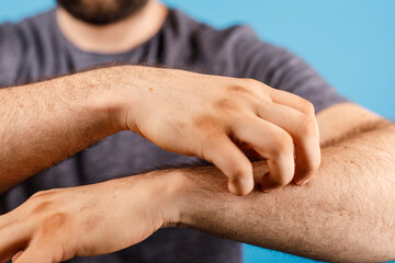 Fototapeta premium A man scratching his arm, depicting skin irritation, allergy, and discomfort. Perfect for healthcare, dermatology, and allergy-related topics.