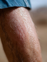 Close up leg psoriasis skin texture makes subject appear uncomfortable, as skin looks irritated and inflamed
