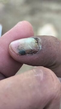 a detached fingernail