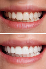 【縦写真】ホワイトニング