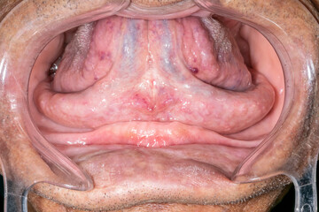 An elder dentistry patient case open mouth, lips retracted with a plastic cheek retractor. Close up front view showing a retracted tongue, and an edentulous and atrophied anterior mandibular arch.