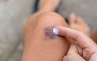 Bruise on a woman leg. Selective focus.