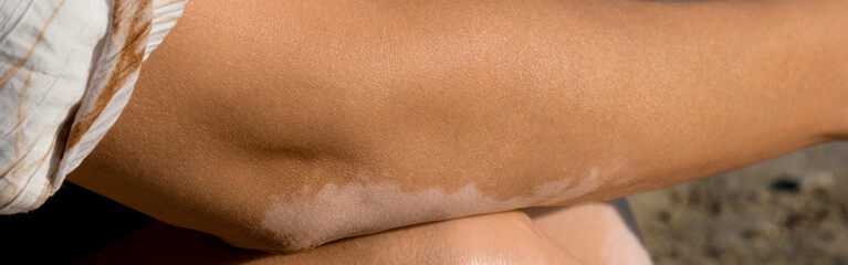 elbow Skin with vitiligo. Female arm with autoimmune disease. pigmentation. banner