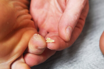 Removal of dry skin from the toes. Removal of corns from the feet