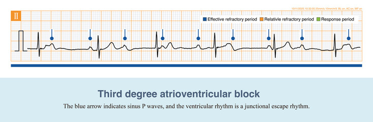Obraz premium In third-degree atrioventricular block, all sinus P waves cannot be transmitted down to the ventricles, and the ventricular rhythm is controlled by the escape rhythm. 