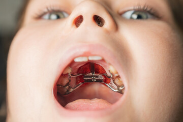 Palatal expander dental device in mouth. Medical and orthodontic equipment inside oral cavity
