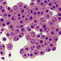 Microscopic view of a cluster of pink cells with dark purple nuclei exhibiting irregular shapes and varying sizes against a white background