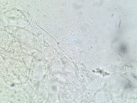 Candida albicans hyphae and pseudohyphae under a microscope, showing filamentous fungal growth and yeast cells, key to candidiasis virulence.