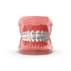Dental orthodontic model of human teeth with braces