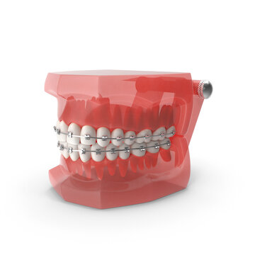 Orthodontic typodont model showing teeth with braces