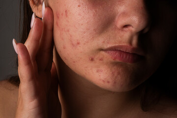 Many pimples. Girl with bad skin. Hormonal acne. Skin acne background. Closeup acne pimple. Treatment for acne skin. Problem skincare. Pimples, pores, scars. Skincare treatment.