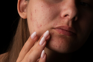 Acne pimples. Girl with bad skin. Skin with acne. Skin acne background. Closeup pimple. Treatment for acne skin. Problem skincare. Pimples, pores, scars. Skincare treatment.