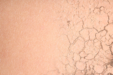 Fototapeta premium Dry skin presented as double exposure with cracked soil