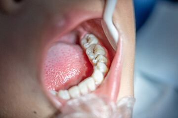 Obraz premium Young dentist healing little boy patient's teeth,Prevention of diseases of baby teeth in child