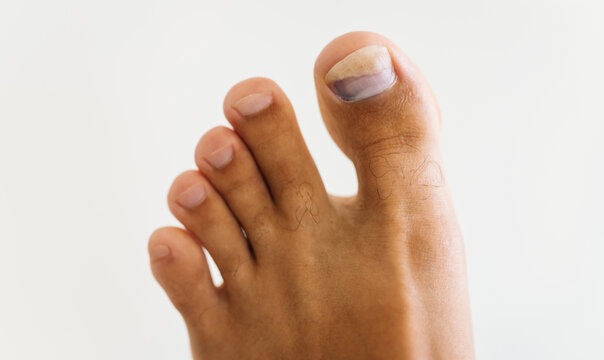 On the big toe, traces of blue discoloration are visible under the nail. Close-up. A man's foot with a sore and blue toe in a home setting. Concept of podiatry and health.