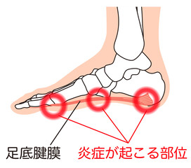 足底筋膜　足底腱膜　足底筋膜炎　足の筋肉