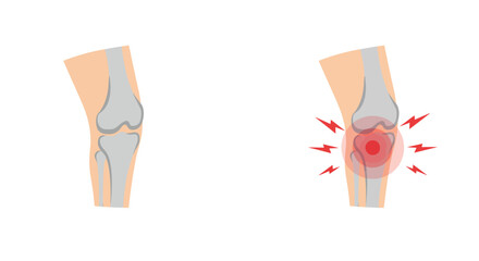 Knee pain anatomy with inflammation highlighted in medical diagram