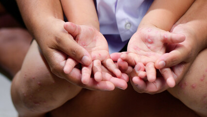 Hand, foot and mouth disease HFMD Human hand of scarlet fever in coxsackievirus palmarosa virus and...