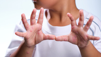 Hand, foot and mouth disease HFMD Human hand of scarlet fever in coxsackievirus palmarosa virus and child hand on white background