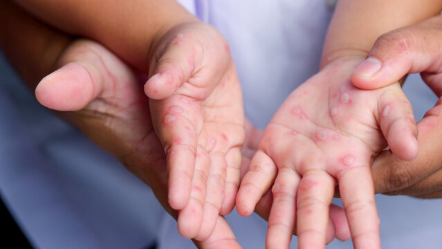 Hand, foot and mouth disease HFMD Human hand of scarlet fever in coxsackievirus palmarosa virus and child hand on white background