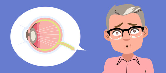 Vector cartoon illustration of an elderly man suffering from cataracts. Infography for medical, healthcare, and ophthalmology-related materials focusing on vision problems and senior care