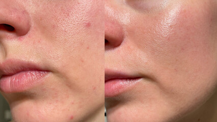 Macro close-up of female face showing before and after skincare results with visible pores, acne, and redness transforming into smooth glowing healthy skin. Perfect for beauty and dermatology themes.