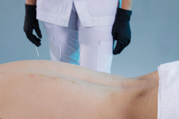 Dry needling acupuncture on the lower back by therapist for pain relief in a clinical setting