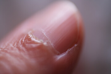 Macro shot of dried toe skin due to eczema