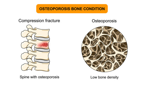 Illustration of osteoporosis bone condition, low bone density, spinal compression fracture, back pain,. Vector for medical, clinical, or educational posters.